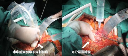 开腹手术具有直观,安全,对肿瘤的治疗全面,彻底等优点.