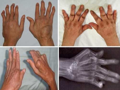 类风湿性关节炎如何辨别?我国的干细胞疗法研究进展到哪一步了?