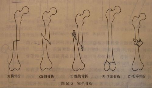 2,完全骨折(横行,斜行,螺旋形,粉碎性,嵌插,压缩,凹陷,骨骺分离).