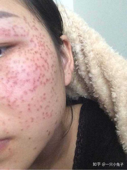 更新一波 很多小姐姐问我返黑期是什么,它和激光