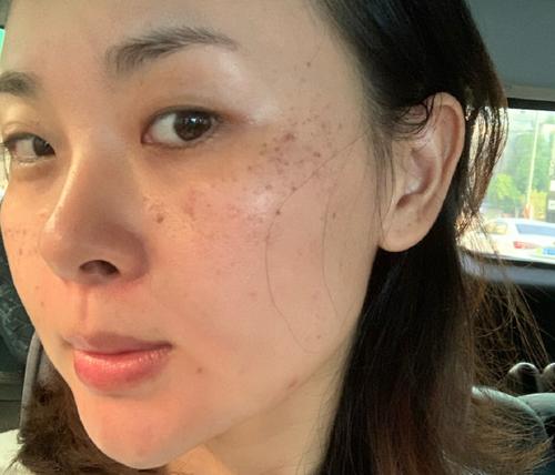 女人未到40岁,提前长出黄褐斑,每天饭后一杯茶,斑点或许能淡化