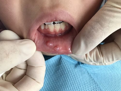 黏液囊肿   易发生在下唇,舌,病史多见于不小心咬到发病部位,表现为时