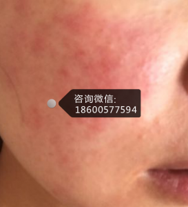 脸部过敏发红痒,皮康王和尤卓尔能一起用吗?