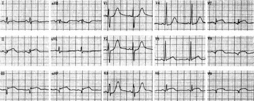 正后壁心肌梗死-心电图临床实习-医学