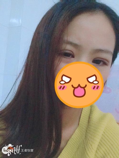 刚做完双眼皮