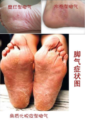 澳普生·教你如何根治脚气?