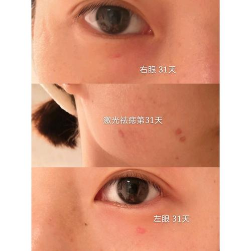 疤痕_凝胶_软膏_修复皮肤_喷雾_香港_海南_百多邦怎么样_祛痣_美妆