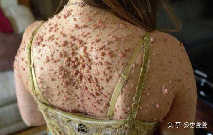 扁平疣是一种比较常见的皮肤小丘疹,常见于脸部或者是脖子还有胳膊