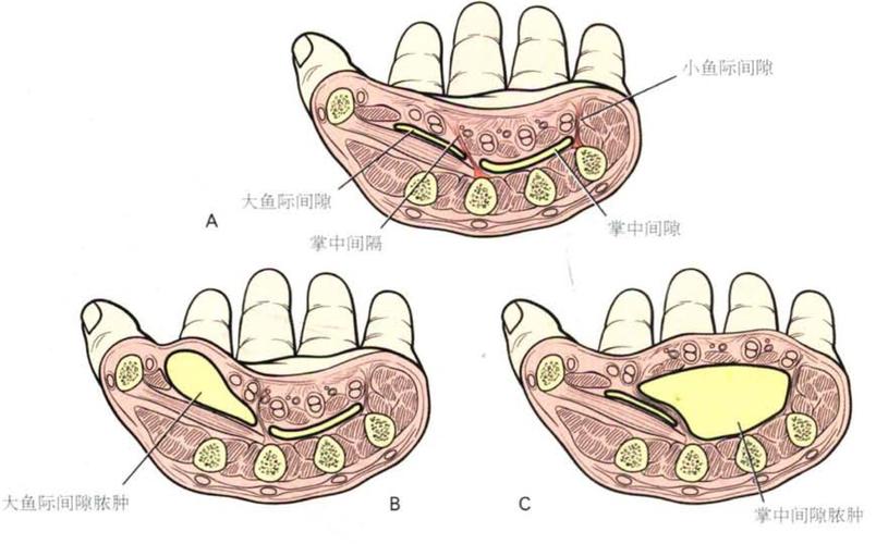 指征:鱼际和掌中间隙感染表现为整个手部感染,尤其是背侧,由于掌侧
