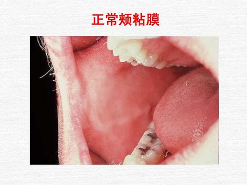 正常颊粘膜