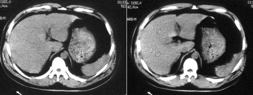 ct诊断:高度怀疑肝左内叶肝破裂. 手术