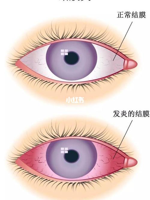孩子过敏性结膜炎长期不好怎么办?