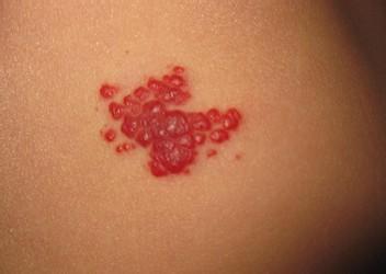 草莓状血管瘤治疗几次能好