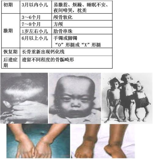 小儿维生素d缺乏性佝偻病 手足搐搦症的护理