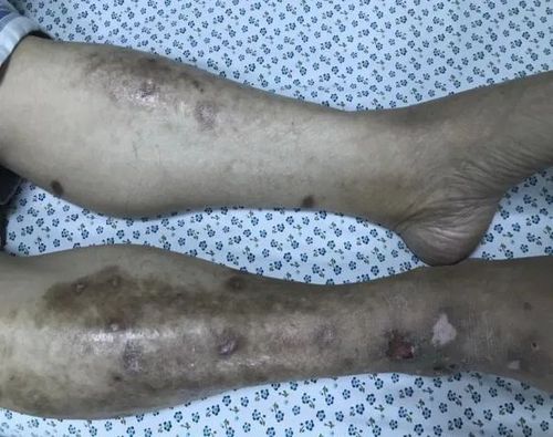 糖友荟这10种糖尿病患者易患高危足当心要截肢