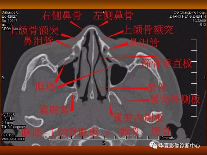 最全的颅骨ct解剖及外伤骨折的诊断