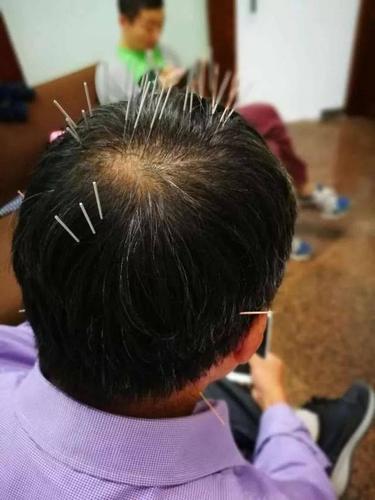 汤氏头针:头部隐藏一阴一阳两个"人体"