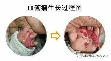 新生儿血管瘤早期图片