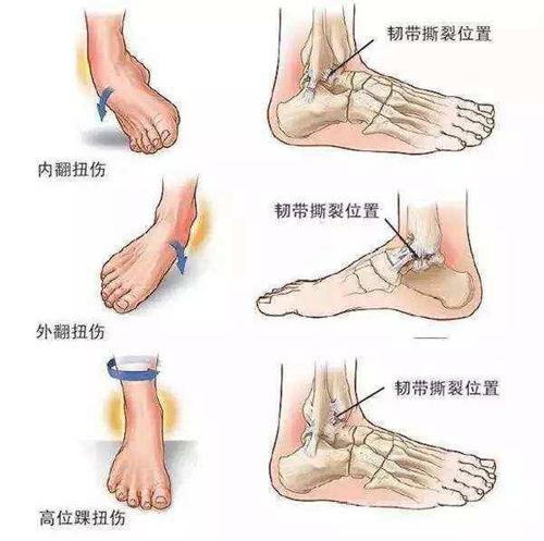 内侧三角韧带损伤时,患者在尝试行足外翻时疼痛症状加剧.