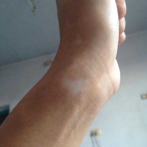 一年前胳膊被热水烫伤了,一个月左右好了,但是后来发现手腕变白色了