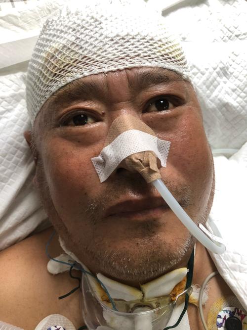 脑梗死溶栓后出血,双侧瞳孔散大,呼吸衰竭,系列救治措施,病人命不该绝