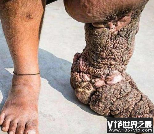 而小编即将要介绍的是世界上最恶心的寄生虫,这份