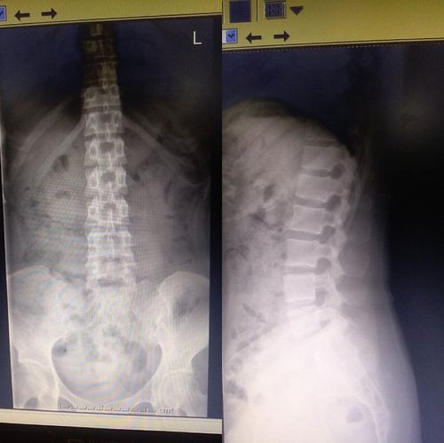 腰椎正侧位x线平片显示:骶骨发育异常---骶骨裂,腰椎骨质未见异常