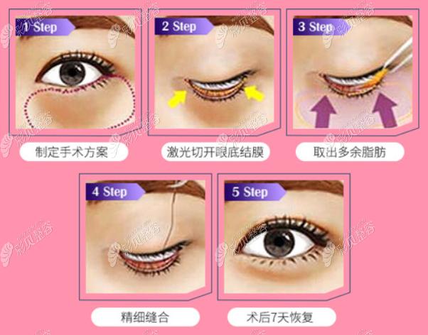 南京华美裴旭芳割眼袋怎么样,找她做内切去眼袋价格贵