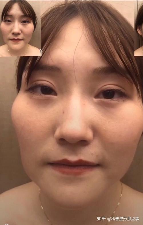 颧骨突出磨骨后对一个人的改变有多大