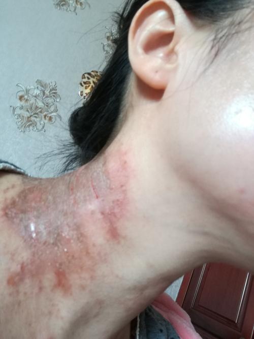砭治神经性皮炎
