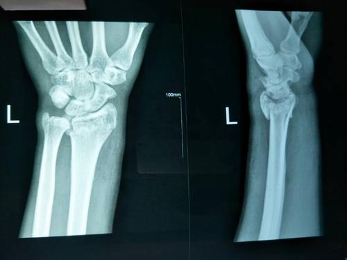 左桡骨远端粉碎性骨折(复位前)