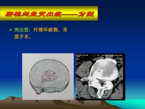 腰椎间盘突出症——分型   突出型:纤维环破裂,常 需手术.