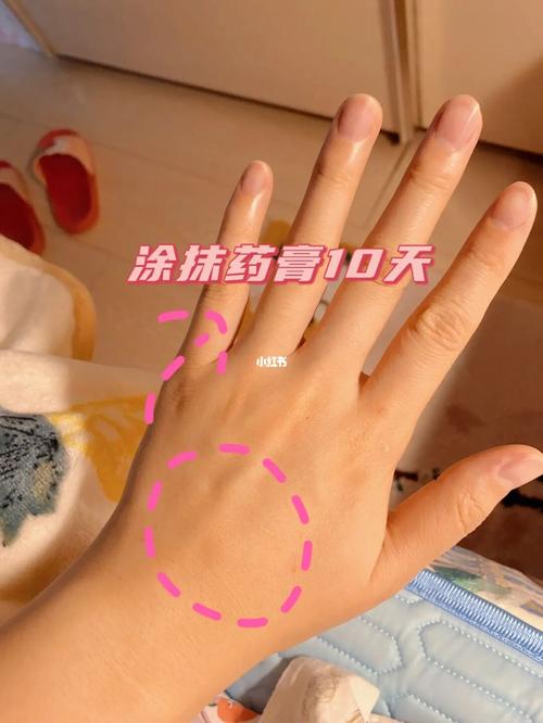 腱鞘囊肿 手背鼓包 教你好办法去除_药膏_腱鞘炎_疤痕