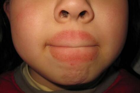 孩子舔嘴唇竟舔出"红胡子"