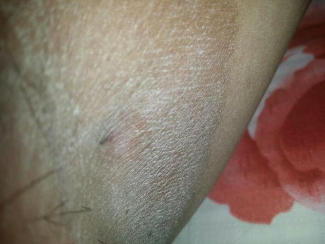 前些日子 发现大腿根内侧有一个粉刺.