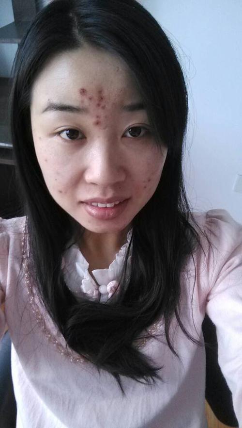 我在美容院挤痘痘后成这样了,会留疤吗?今天第三天了