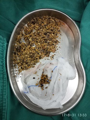 清远市清城区人民医院 谢文锋 文章列表 >肾结石的危害  右肾铸型结石