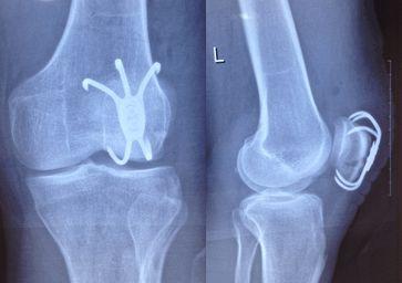 髌骨骨折这几种手术方法你都get了吗?