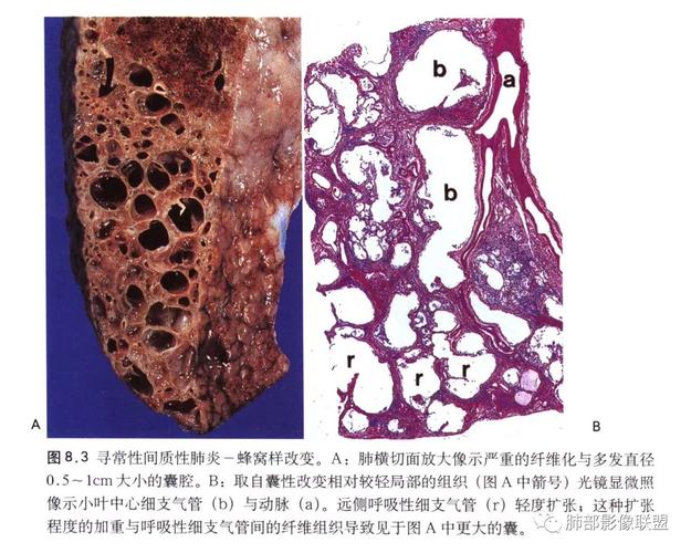 特发性间质性肺炎病理,影像及临床解析——丁啸