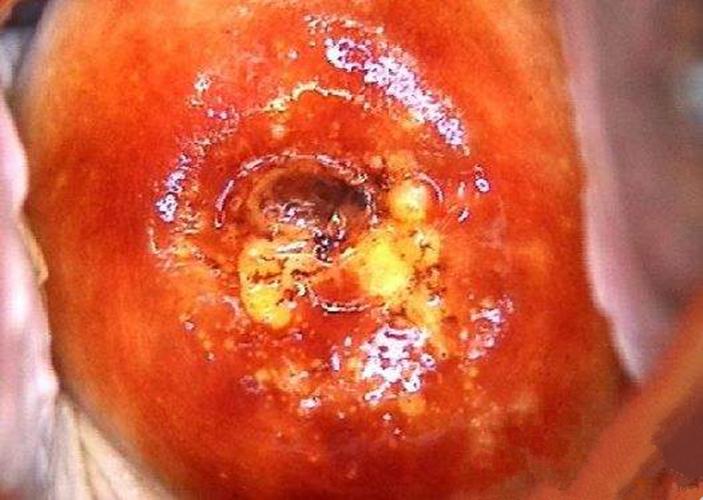 慢性宫颈炎严重症状的图片