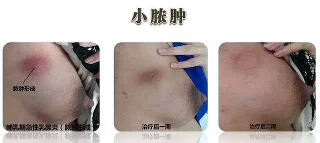医学科普|急性乳腺炎脓肿,不要急着切开!