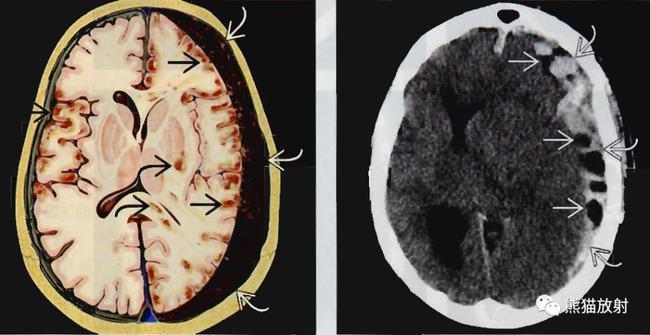 硬膜外血肿与急性硬膜下血肿在ct上的区别