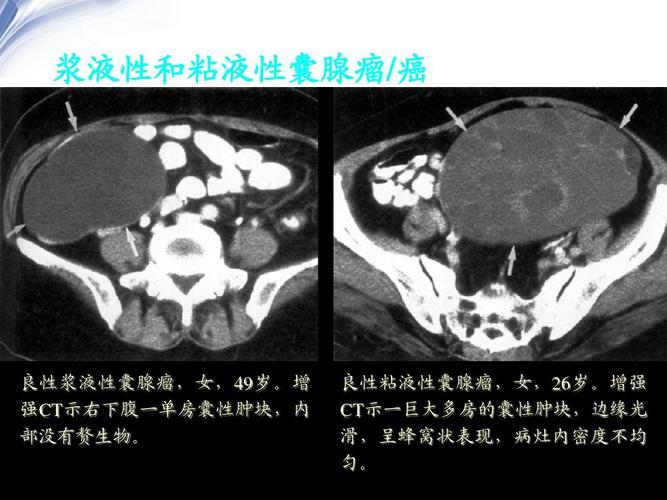 最新 卵巢肿瘤ct影像诊断 课件ppt
