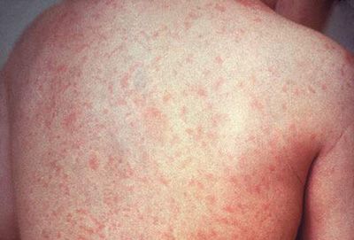 麻疹病毒的麻疹疫苗