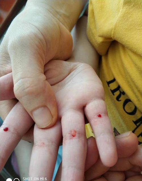 孩子厌食被按住挑疳积 是中医育儿还是残忍旧社会方法