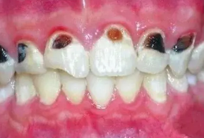 长出可乐牙就是痛苦的开始