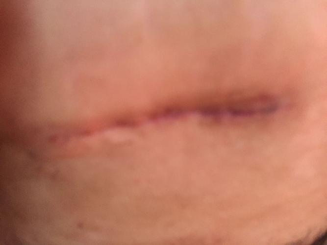 输软管结扎吻合术手术后刀口一直红有事吗