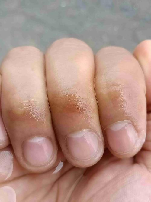 手指关节起泡变色死皮什么情况