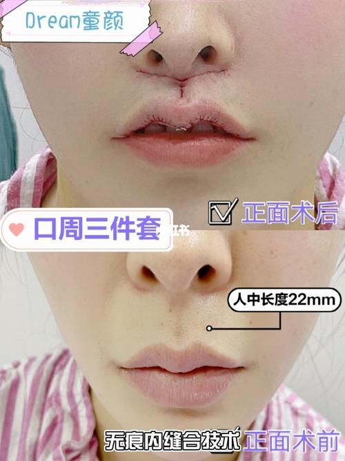 无痕人中 人中缩短 人中窝_梦诺怎么样_童颜_减龄_美妆_医美整形