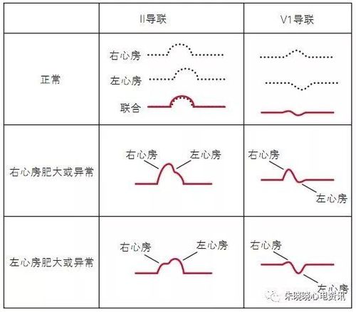 p波异常心电图口诀